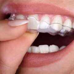 Things to know before you get your Invisalign.